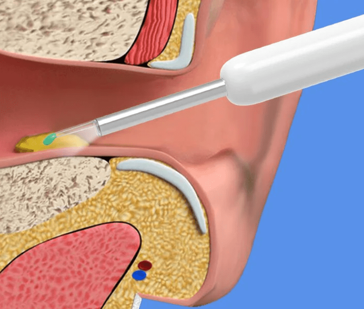 Otoscope Nettoyage dans Oreille